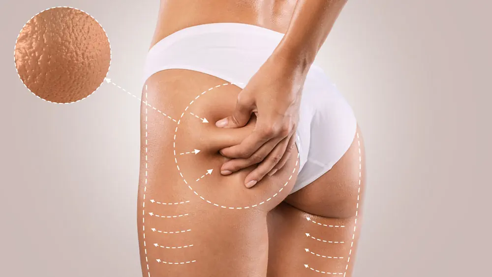 Cellulite Mesotherapy